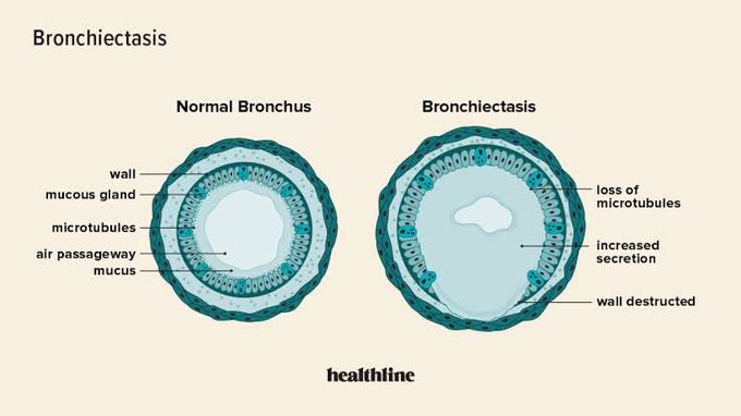 Affect of broncheictasis on lungs