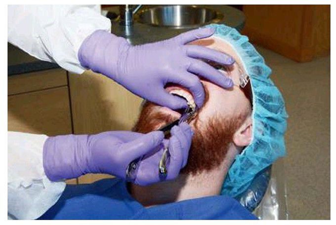 Mandibular extractions