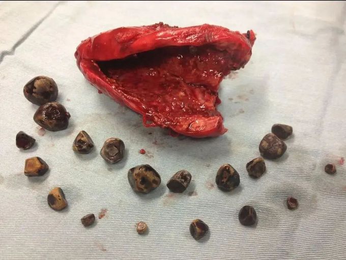 Gallbladder with multiple gallstones