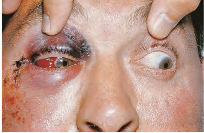 Subconjunctival Hemorrhage in Zygoma Fracture