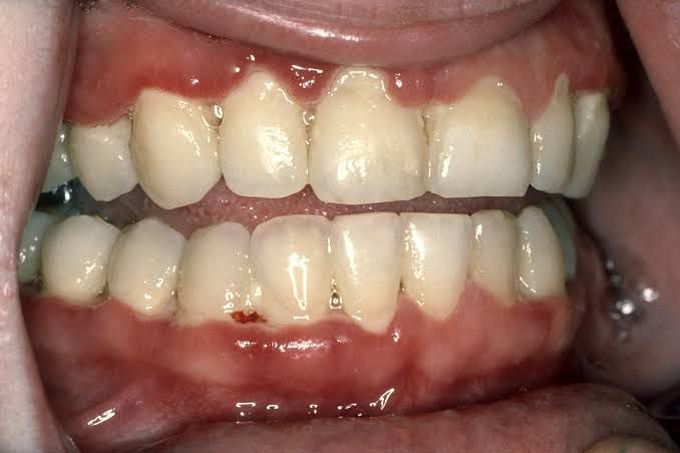 Necrotizing ulcerative gingivitis