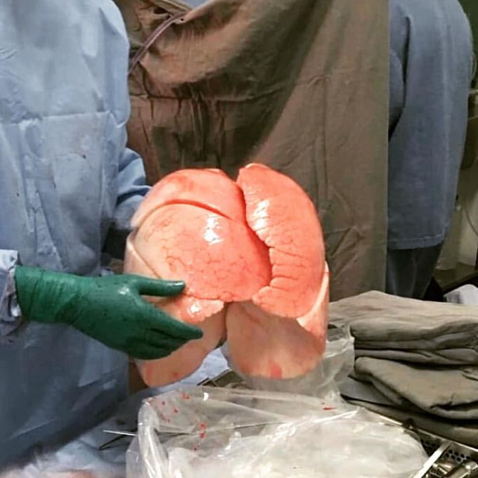 Lungs before transplantation