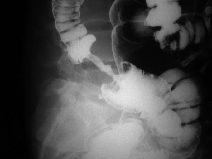 "Apple Core Sign" on X-ray in a patient with Colon Cancer