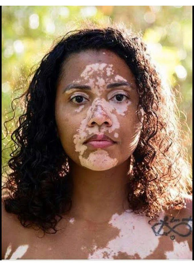 Vitiligo