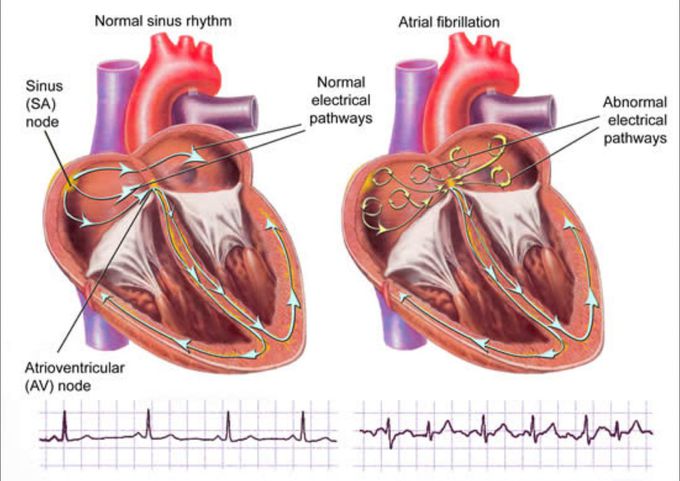 Normal sinus rhythm vs atrial fibrillation