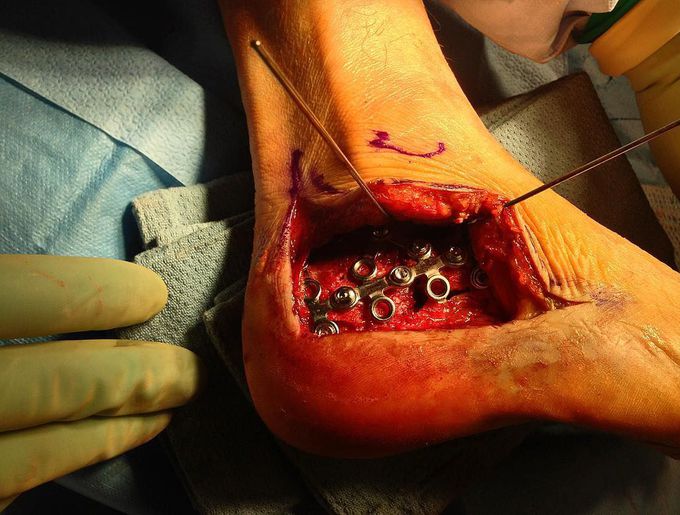 Calcaneus fracture surgery, view of hardware placement using plates and screws for fixation!!