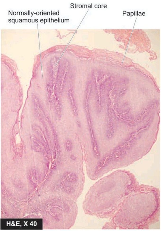 Squamous cell papilloma.