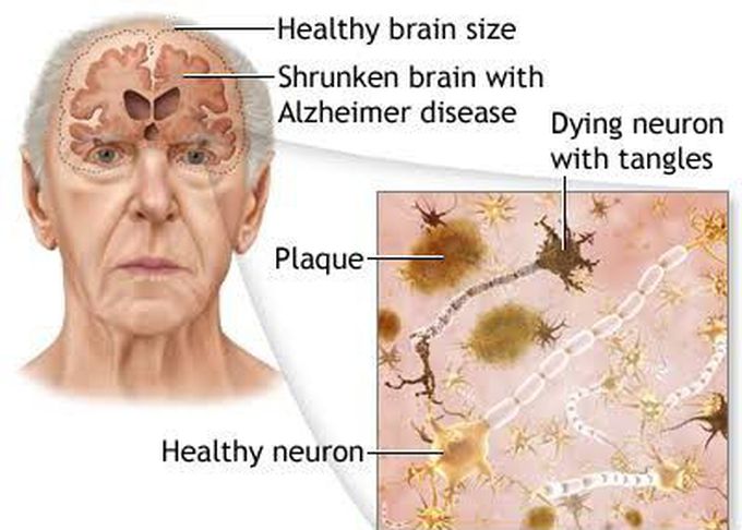 Alzheimers disease causes