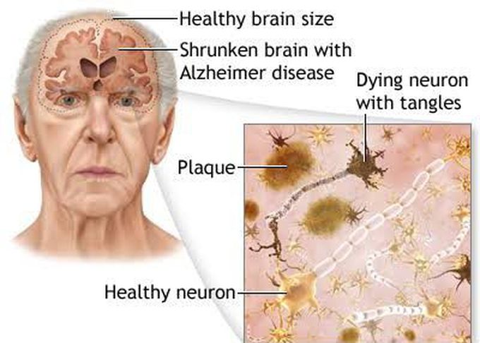 Alzheimers disease causes