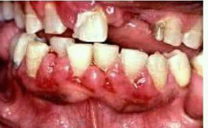 Name the disease??