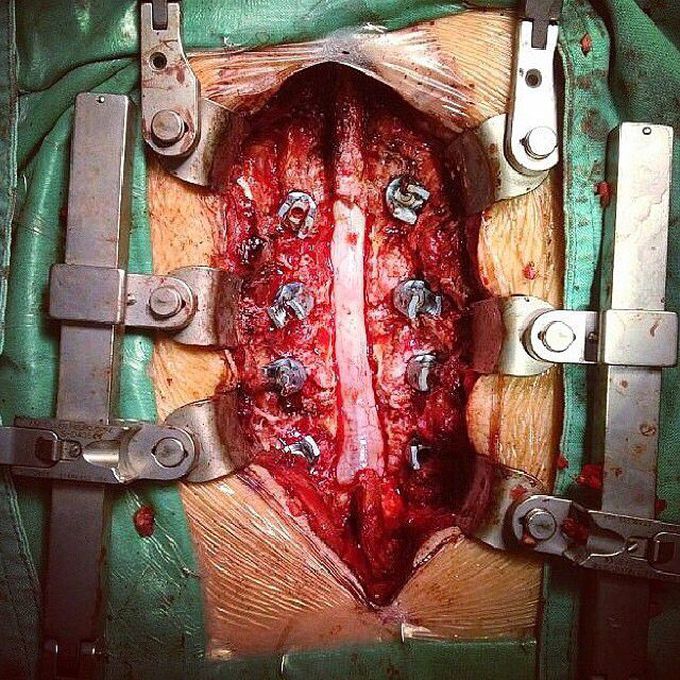 Spine Fusion Instrumentation