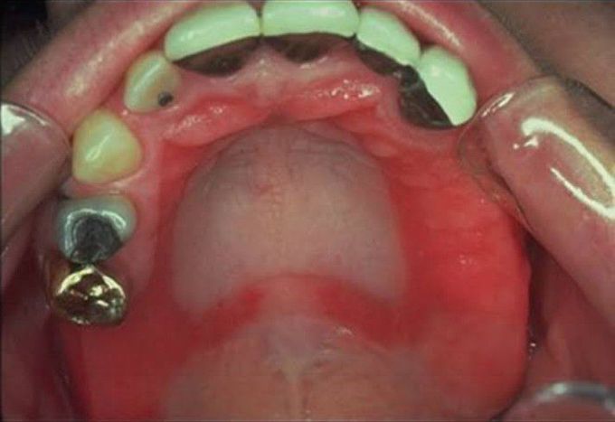 Denture stomatitis