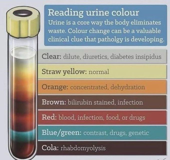 urine colour chart diabetes