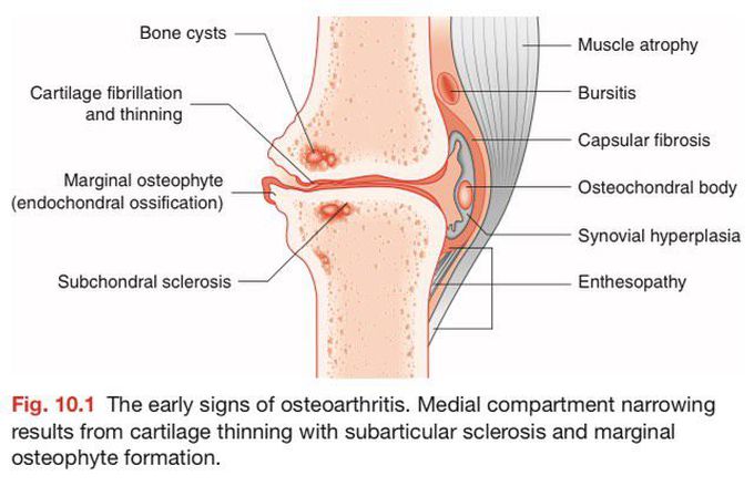 Osteoarthritis-Early signs