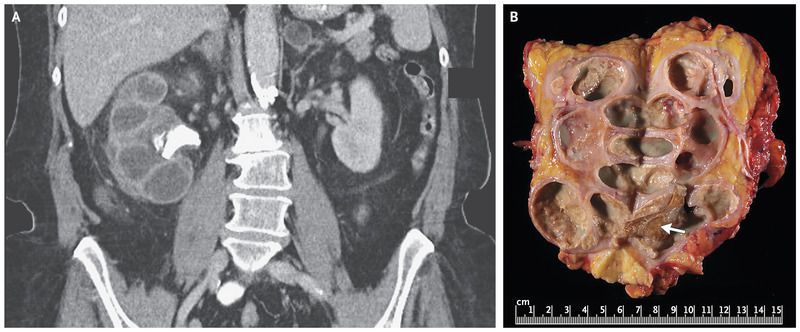 Xanthogranulomatous Pyelonephritis Nejm Pathology Outlines