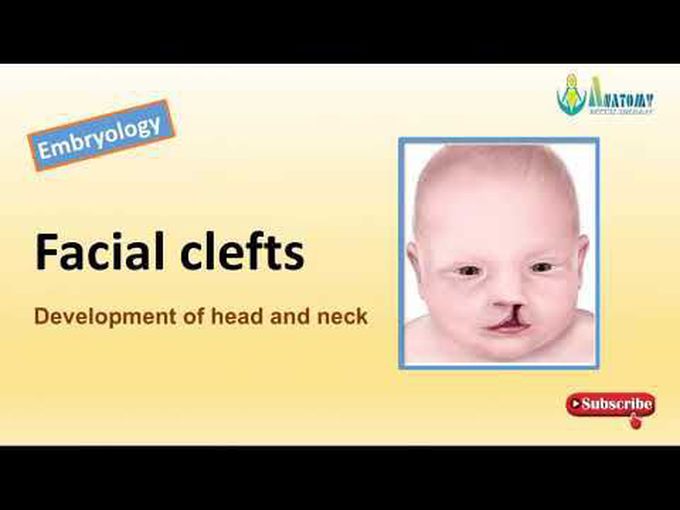 Facial Clefts