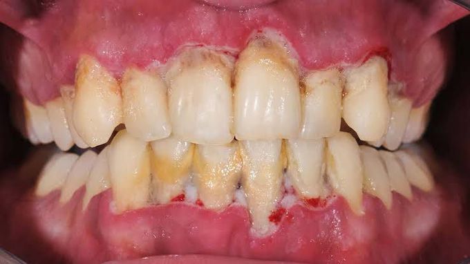 Symptoms of periodontal diseases