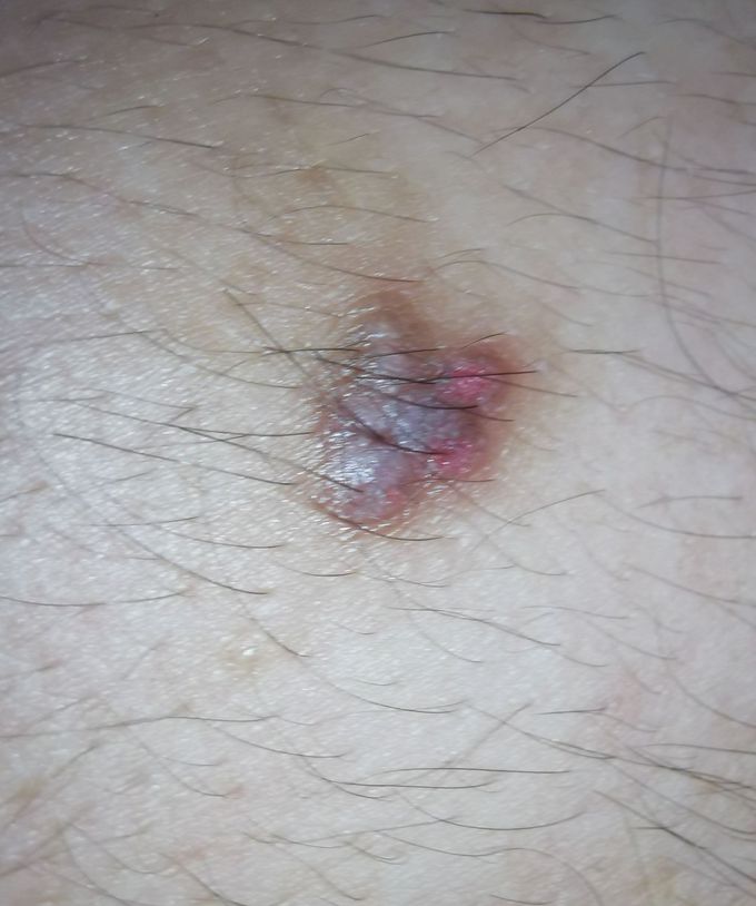 Dermatology