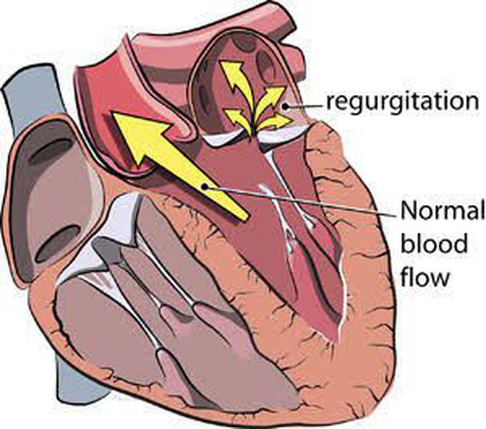 Symptoms of Mitral regurgitation