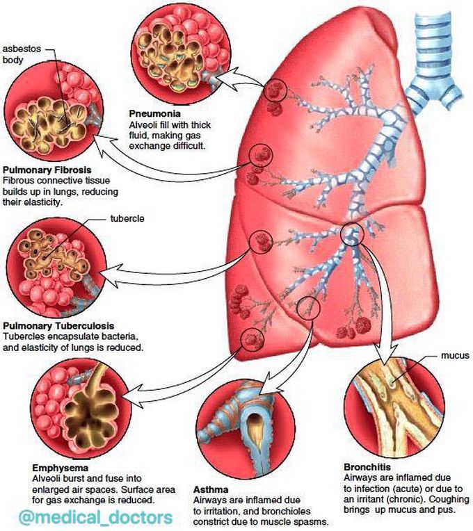Lung disease