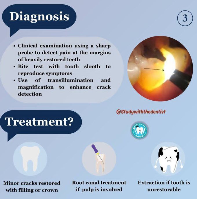 Crack Tooth Syndrome II