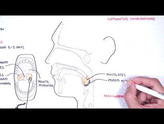 Introduction to Streptococcal Pharyngitis