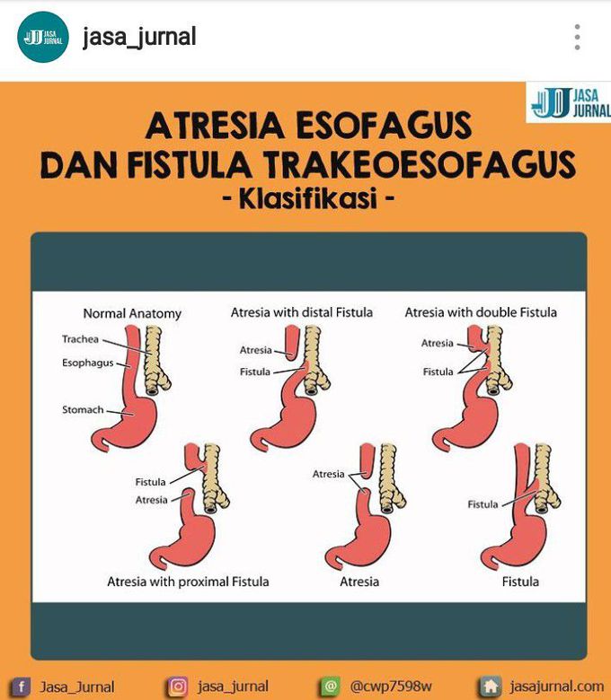 Classification of atresia oesofagus