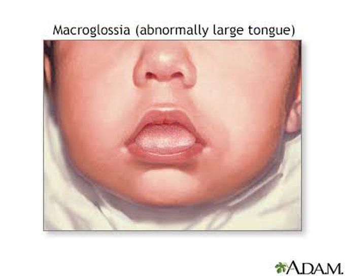 Symptoms of macroglossia