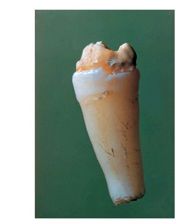Turner tooth