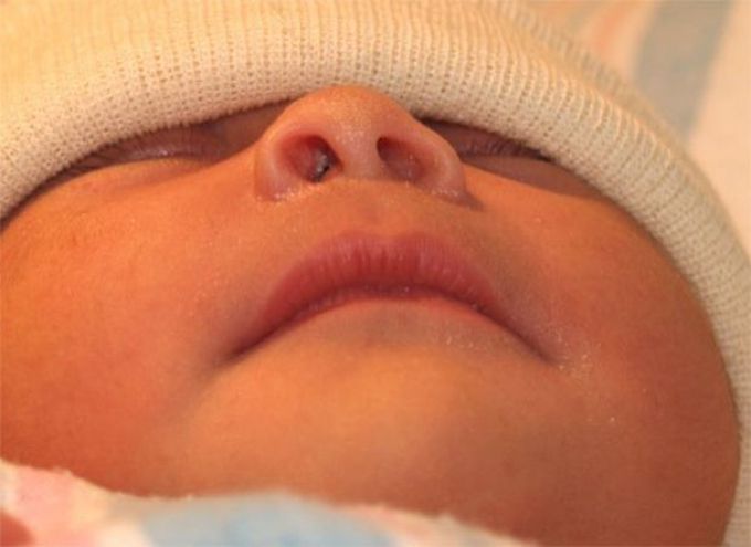Nasal deformities in new born .