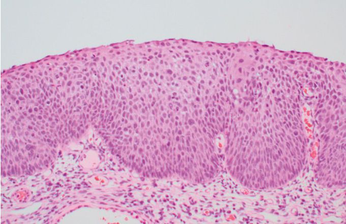 Cervical disease