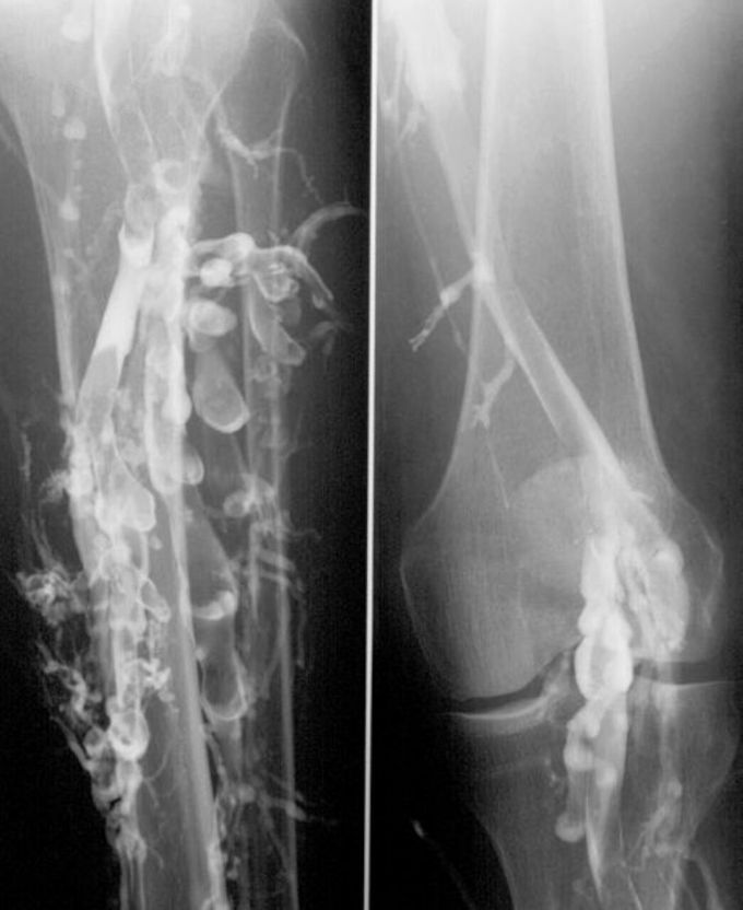 Phlebography in a patient with deep venous thrombosis (DVT)