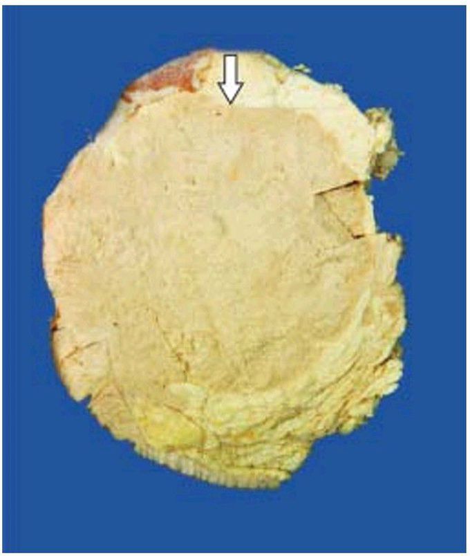 Medullary carcinoma breast