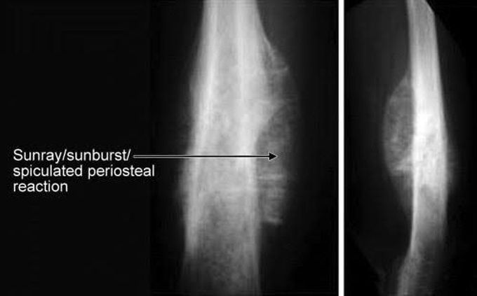 Sunray or sunburst appearance of bone