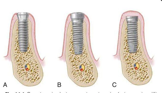 Dental implant surgery