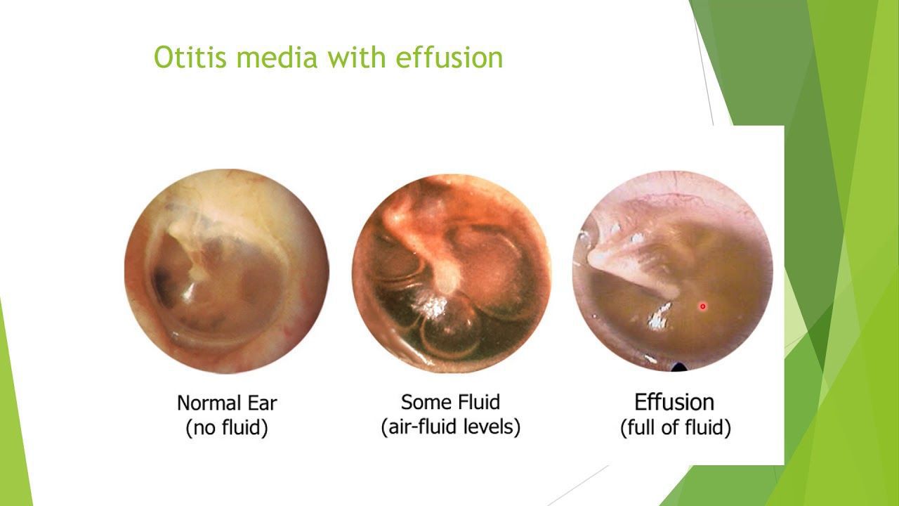 serous otitis media. - MEDizzy