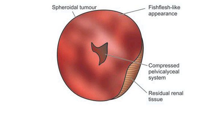 Nephroblastoma