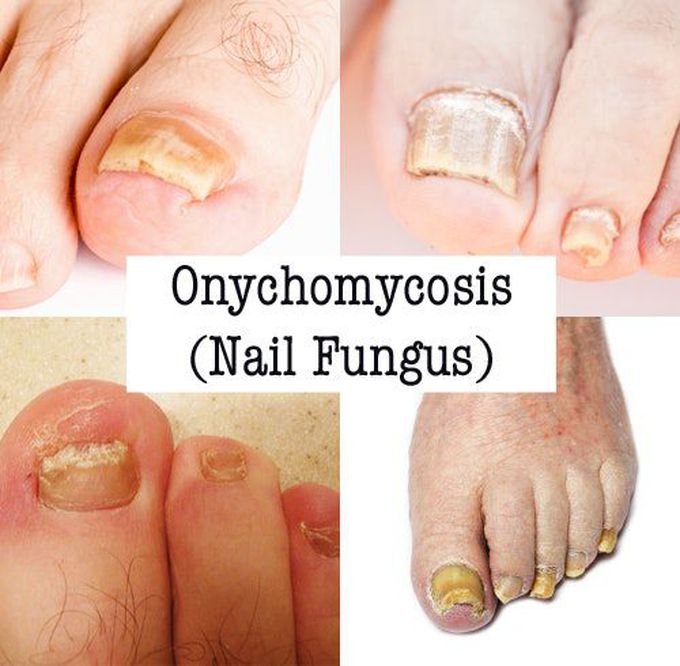 Cause of Onychomycosis