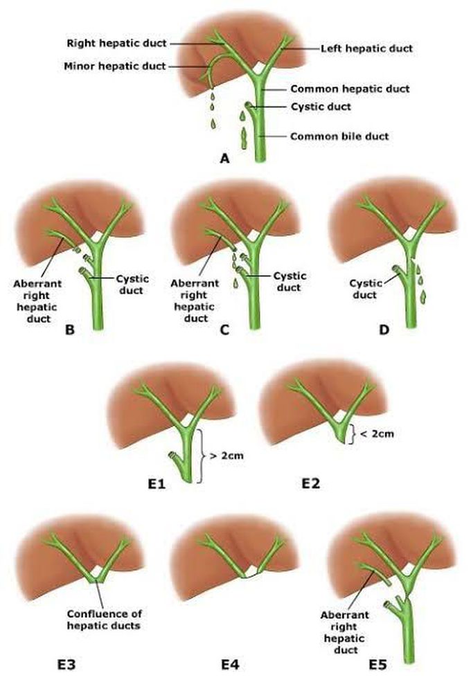 Strasberg classification of biliary Injury