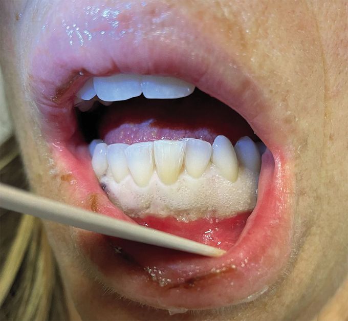 Gingival Infiltration in Acute Monocytic Leukemia
List of authorsIMAGES IN CLINICAL MEDICINE

Gingival Infiltration in Acute Monocytic Leukemia