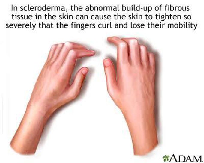 Scleroderma : Multi systemic connective tissue disease cause by degeneration and fibrosis of skin and viscera...Most common in female