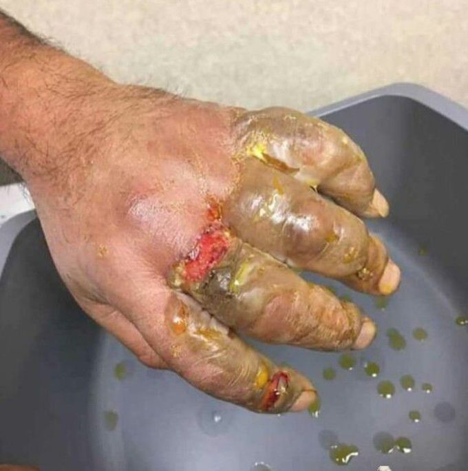Severe hand burn due to hot oil
