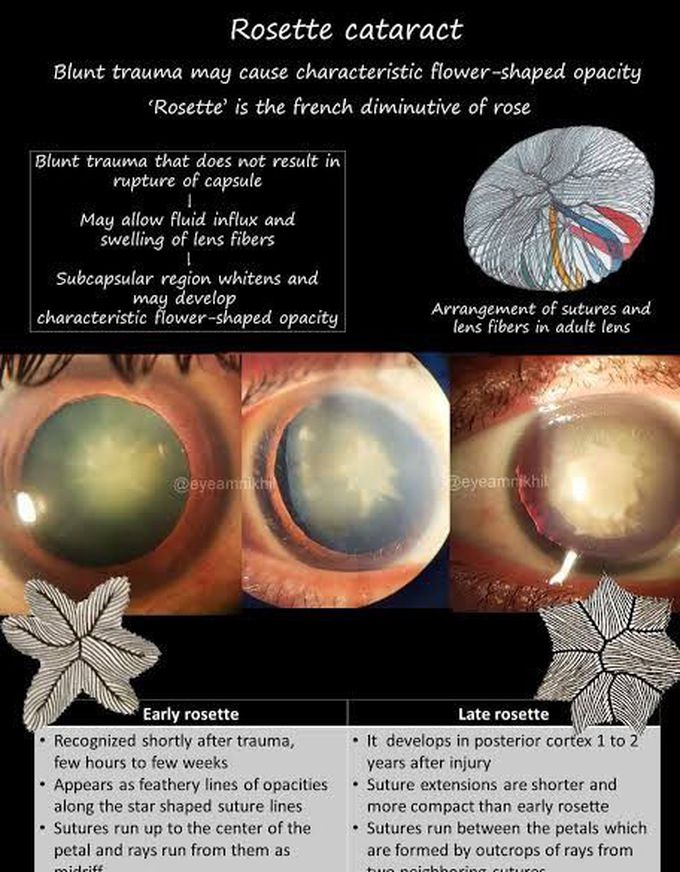 Rosette Cataract