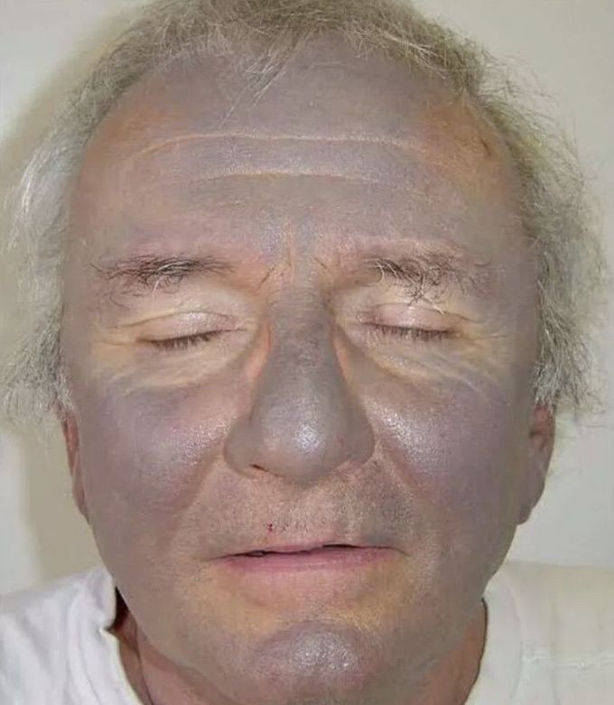 Argyria