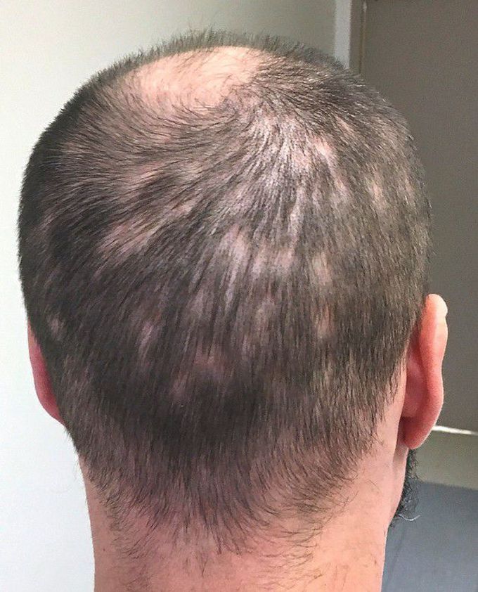 Syphilitic Alopecia