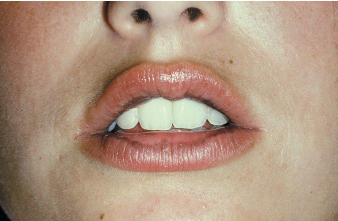 Minocycline-associated Pigmentation - MEDizzy
