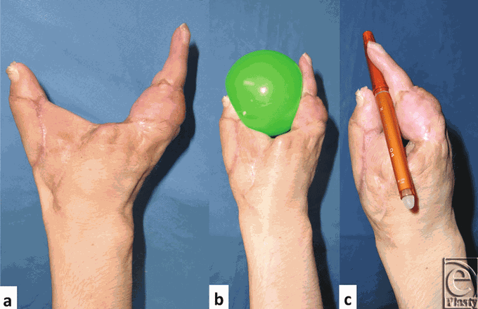 (a) The distance between the thumb and the little finger was 10 cm. (b) He is able to hold and throw a ball comfortably as well as (c) hold a pen. 