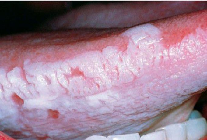 Hairy leukoplakia