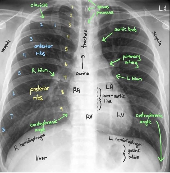 Thoracic X Ray