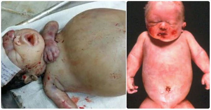 Non-Immune Hypropes Fetalis